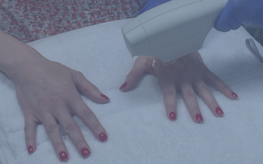 BBL Light Treatment + Cosmetic Fillers for Hand Rejuvenation
