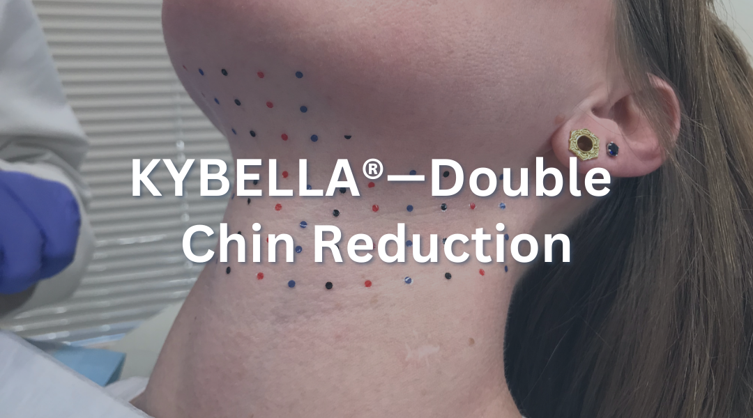 KYBELLA®—Double Chin Reduction