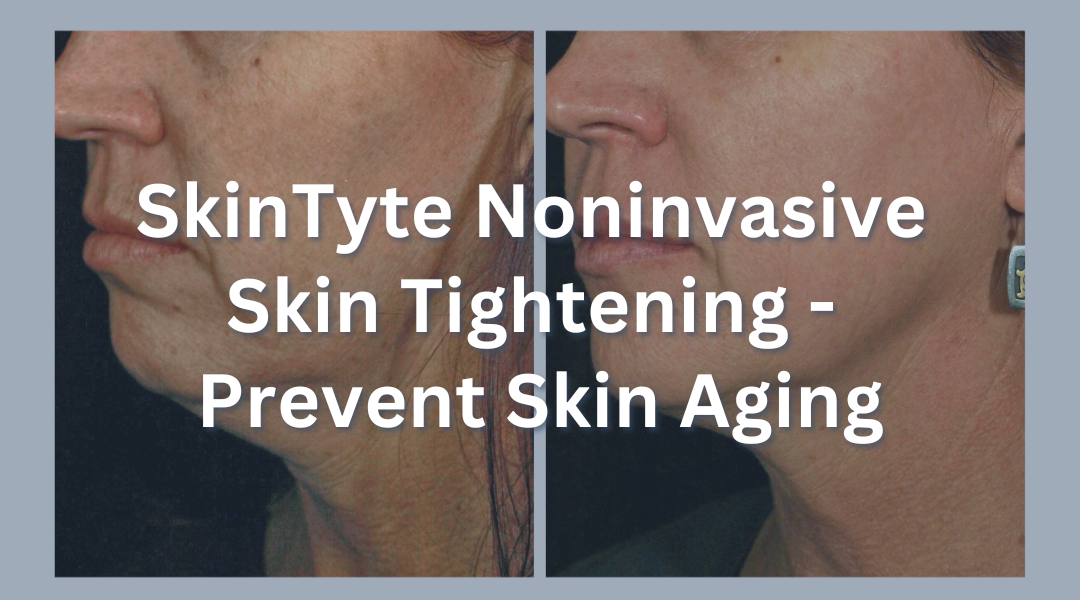 SkinTyte Noninvasive Skin Tightening – Prevent Skin Aging